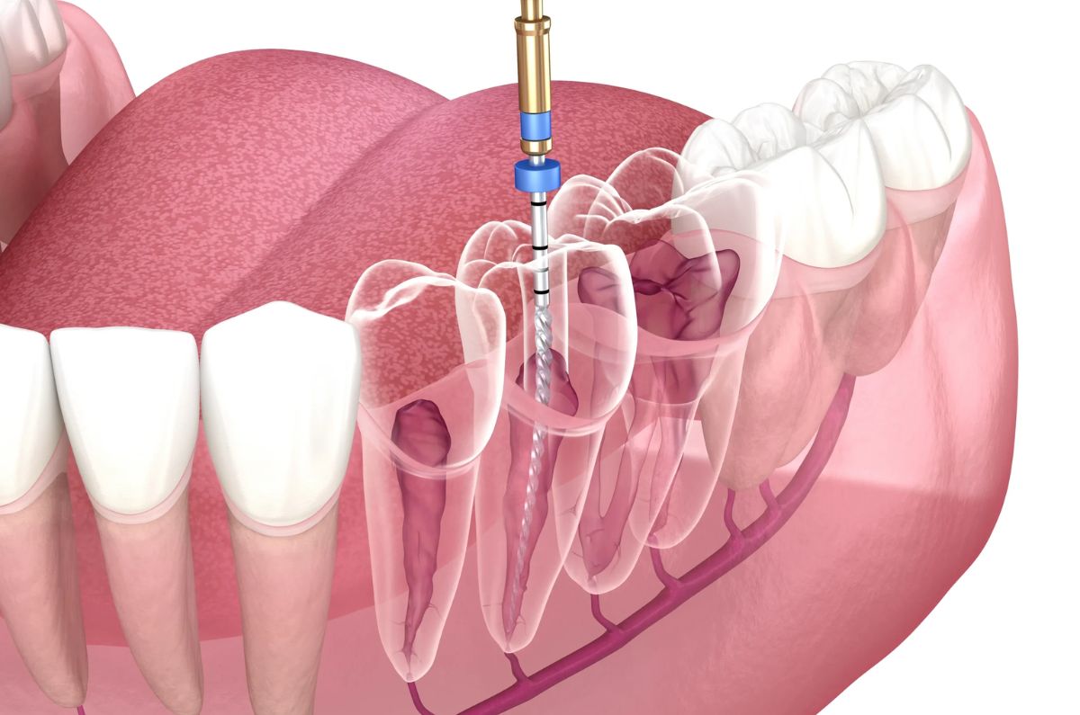 Painless Root Canal Treatment